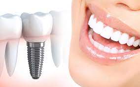 Імплантація зубів під ключ за приємними цінами: поради експертів